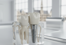 Close-up of a highly detailed dental implant with a titanium screw embedded in a bone-like structure and topped with a realistic ceramic crown, presented in a clean, sterile environment. The background is softly blurred with indistinct European architecture, suggesting a setting in Belgium.